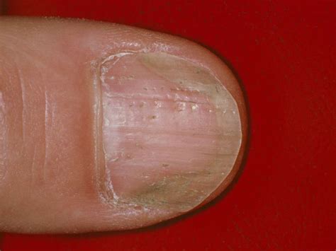 Nail psoriasis or fungus?: Differences, symptoms, and outlook