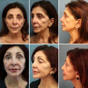 Botox For Neck Bands Before And After » Facial Injections: Info, Prices ...