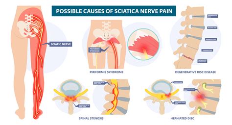 Sciatic Pain Chiropractic Care - Johnstown, CO Chiropractic Care