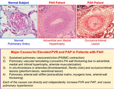 Pulmonary Artery Histology