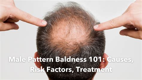 Male Pattern Baldness 101: Causes, Risk Factors, Treatment - Homage ...