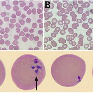 Figure. Babesia microti detected on Wright-stained peripheral blood ...