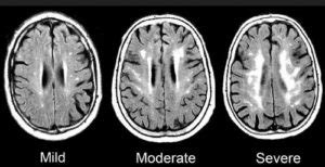 👉 Microvascular Ischemic Disease