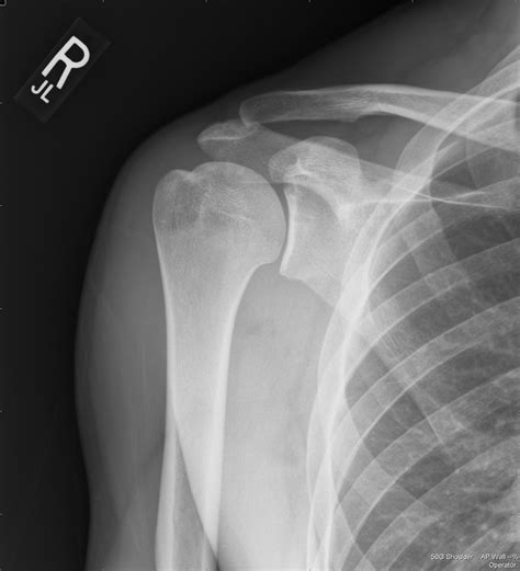 Xray Shoulder Normal