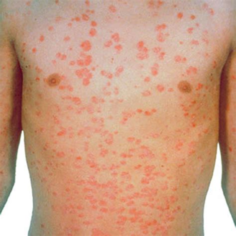 Guttate Psoriasis - Causes, Symptoms, Treatment, Diet & Home Remedy