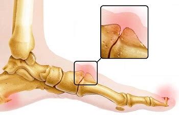 Lump On 5th Metatarsal