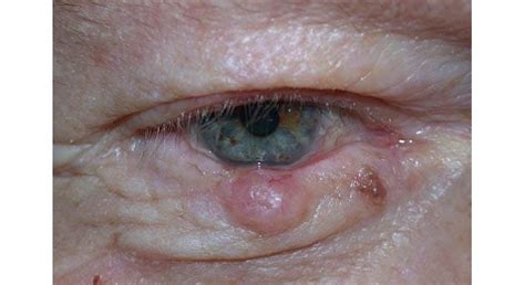 Eyelid Skin Cancer - mivision