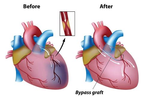 Coronary Artery Bypass Graft Surgery (CABG) - Cardiovascular ...