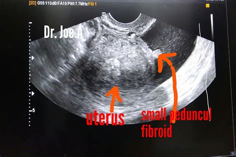 Ultrasound imaging: Small pedunculated fibroid