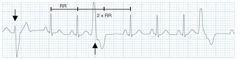 Want Transient President pvc premature ventricular contraction money ...