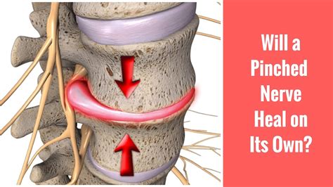 how to fix a pinched nerve - ralph-ferguson