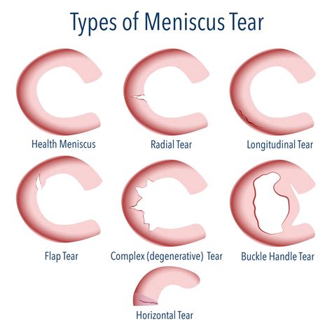 Arthroscopic Meniscectomy | Partial Meniscectomy