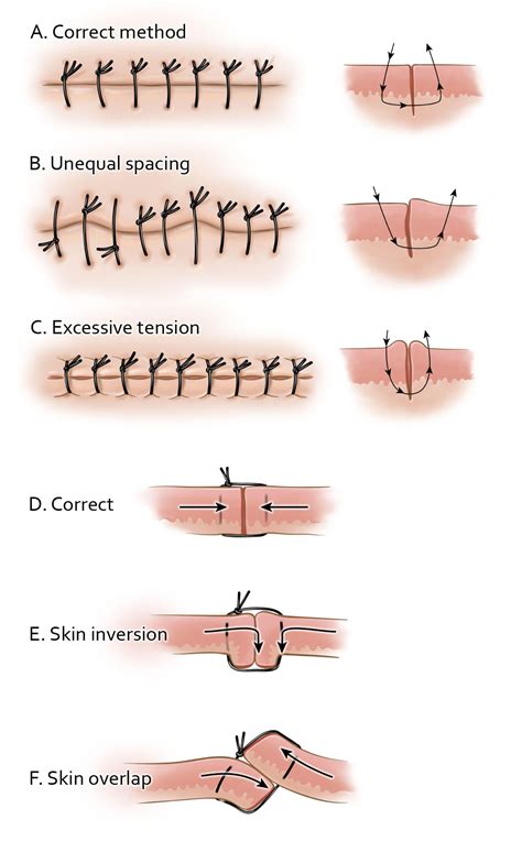 Surgical Suturing To Close A Wound