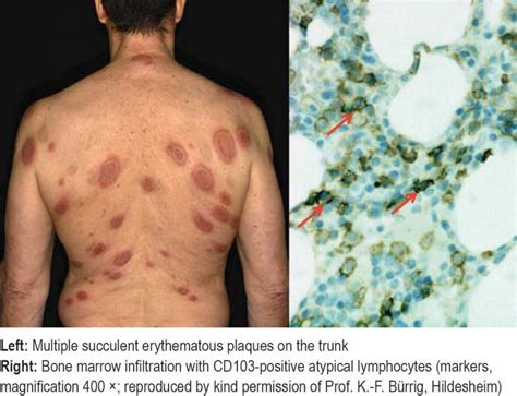 Sweet’s Syndrome as Precursor of Hairy Cell Leukemia (06.03.2020)