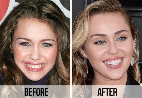 Miley Cyrus Clear Braces - NatasjaJiri