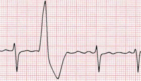 The whole ECG - a really basic ECG primer