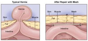 Treatment | Premier Hernia Center