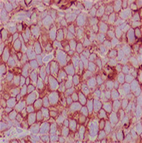 Immunophenotype features (x400) suggesting of large neoplastic lymphoid ...