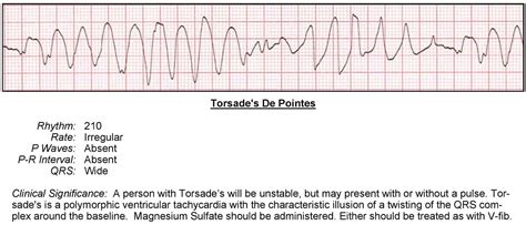 Polymorphic Ventricular Tachycardia Ecg