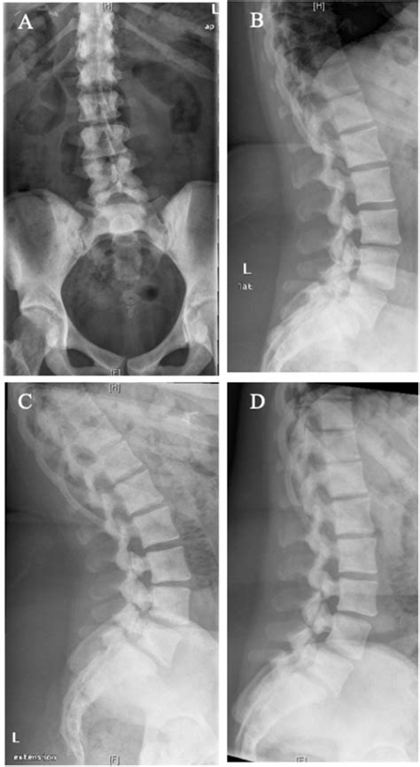 X-rays of lumbar spine showing sclerosis of the bones and spondylolyses ...