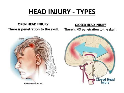 Head injuries Overview