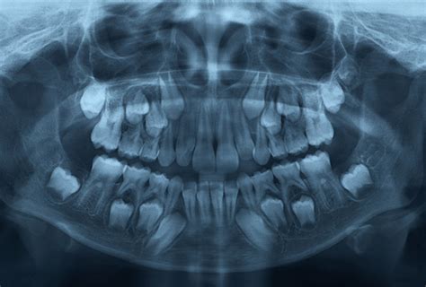 Pediatric Dental X-rays (Radiography) - Lonestar Kid’s Dentistry