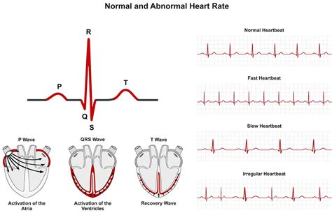 Ventricular Arrhythmia: Causes, Symptoms Treatment, 45% OFF