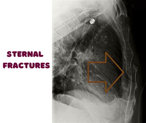 Sternal Fractures: Unveiling Causes, Symptoms, And Recovery