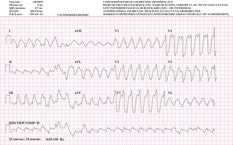 ECG Educator Blog : Ventricular Tachycardia (VT)