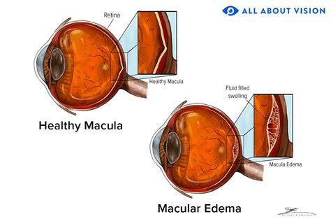 Macular Edema - All About Vision