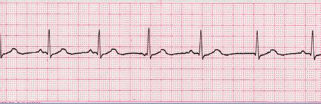 Wandering Atrial Pacemaker Rhythm Strip