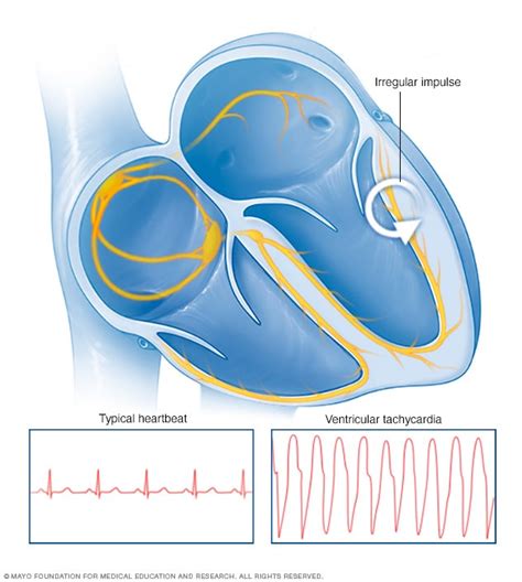 Ventricular tachycardia - Symptoms and causes - Mayo Clinic