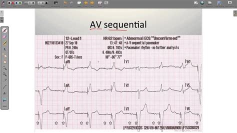 Dual Chamber Pacemaker Ecg