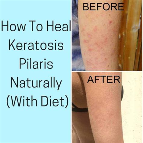 How To Heal Keratosis Pilaris With Diet - Pure and Simple Nourishment