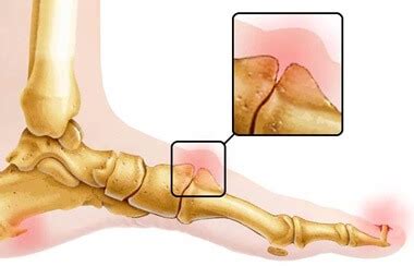 Cyst On Top Of Foot Deals | emergencydentistry.com