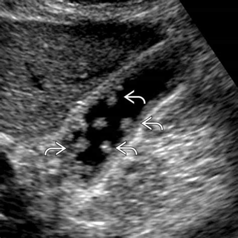 Gallbladder Polyps | Radiology Key