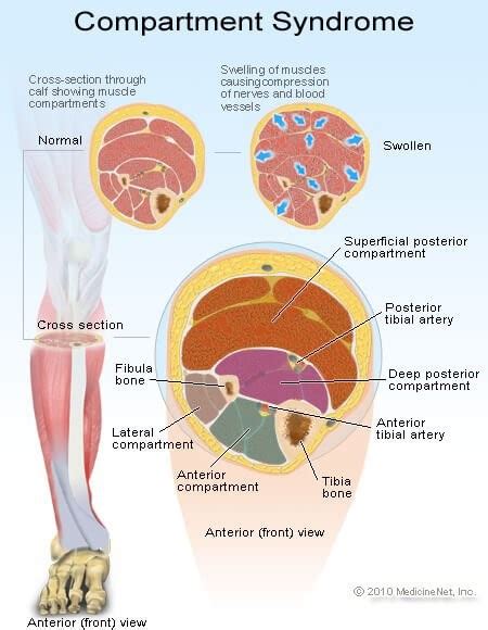 Compartment Syndrome Treatment in Sydney | Podiatry First