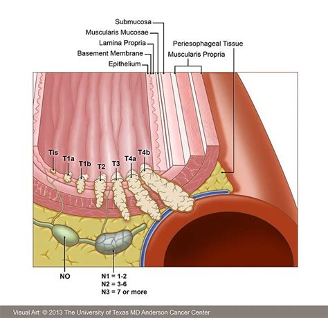 Symptoms Of Late Stage Esophageal Cancer - CancerWalls