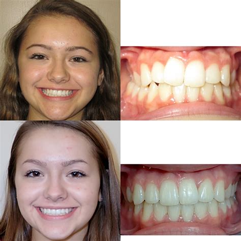 Before & After Braces | Wazio Orthodontics