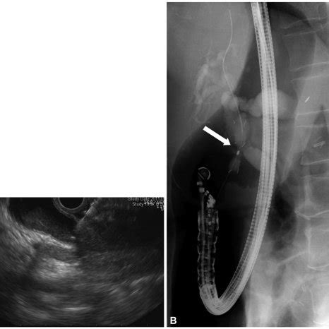 Choledochoduodenostomy. Due to duodenal partial obstruction, a ...