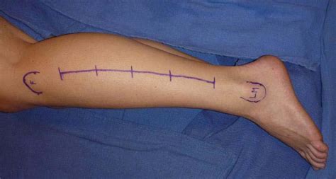 Compartment Syndrome - JUNIORBONES