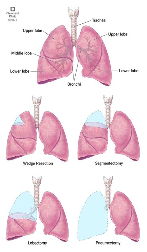 Lung Resection Surgery: Procedure, Details and Recovery