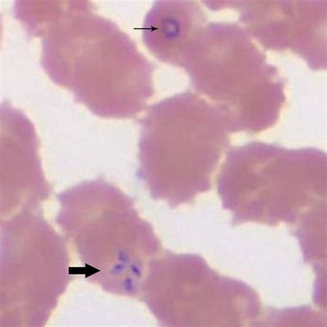 Figure - Babesia microti Infection, Eastern Pennsylvania, USA - Volume ...