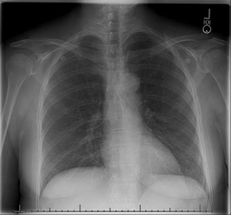 Hennepin Ultrasound | Sternal Fracture Missed on X-ray