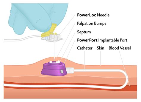 Port A Cath Catheter