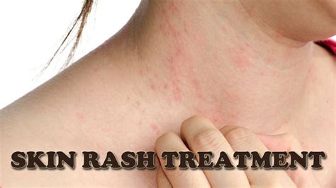 Skin Rash Treatment - How to Treat Itchy Skin Rash Naturally - YouTube