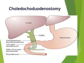 Choledochoduodenostomy