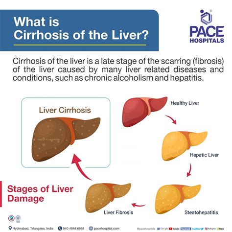 Liver Cirrhosis – Symptoms, Causes, Complications and Prevention