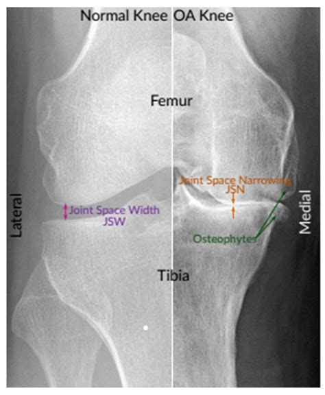 Diagnostics | Free Full-Text | Identifying Severity Grading of Knee ...