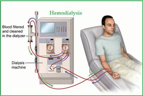 Treating Chronic Kidney Disease with Dialysis - Premier Surgical